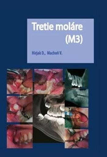 Tretie moláre (M3) - Vladimír Machoň, Dušan Hirjak