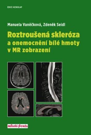 Roztroušená skleróza a onemocnění bílé hmoty v MR zobrazení - Zdeněk Seidl, Manuela Vaněčková