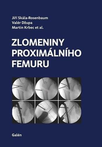 Zlomeniny proximálního femuru - Kolektiv - Krbec Martin