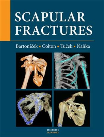 Scapular fractures - Jan Bartoníček, Ondřej Naňka, Michal  Tuček, Christopher Colton