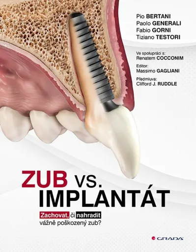 Zub vs. implantát - Bertani Pio, Generali Paolo, Gorni Fabio, Testori Tiziano